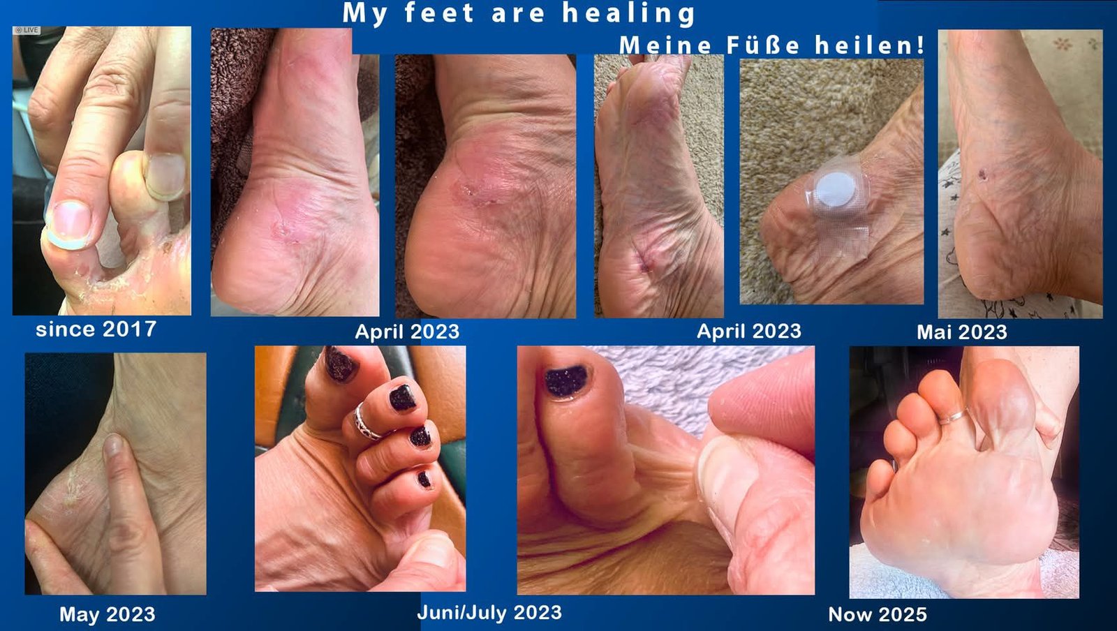 Feet healing progression 2017 to 2025